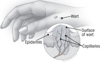 The structure of the wart on the hand