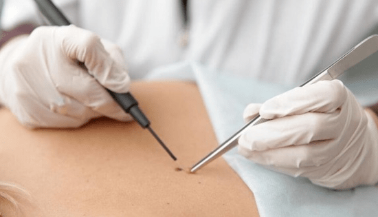 Papilloma removal characteristics