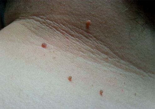 Neck papillomas