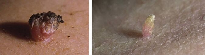 Papillomas on the skin