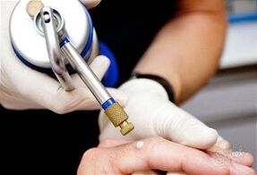 methods of removing papillomas on the skin