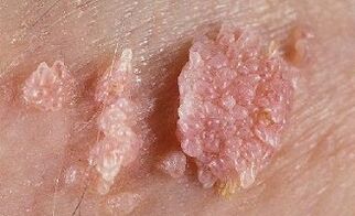 picture of human papilloma virus