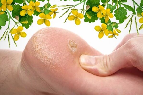 ways to treat warts