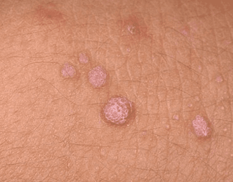 flat warts on the body