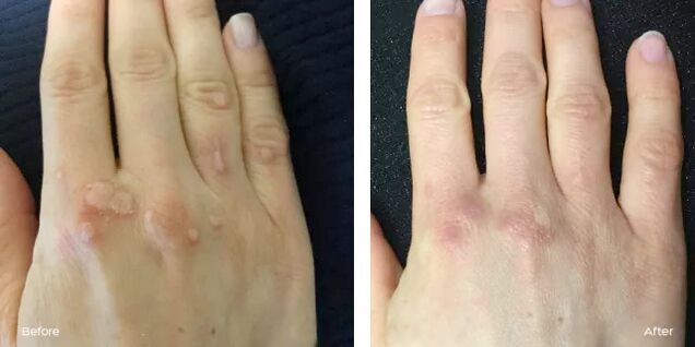 successful elimination of warts after using Rimovio gel review by Andrew 2